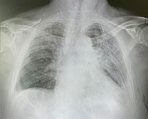 Post Operative Chest X Ray The Images Show The Postoperative Outcome Download Scientific