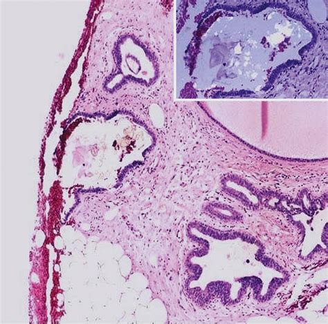 Fibrocystic Change And Usual Epithelial Hyperplasia Of Ductal Type