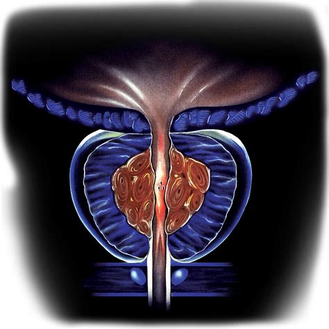 Better Understand Developing Treatments Of Prostate Cancer Aapc Knowledge Center