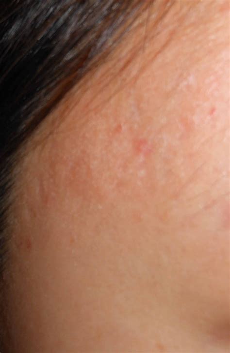 Acne Skin Care Acne Scar Before And After Retin A Tretinoin Treatment