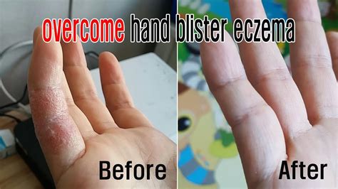 Overcome Hand Blister Ezemadermatitishow To Save The Hand Blister