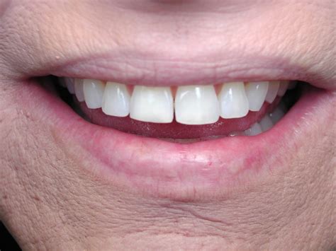 Bonding Beautiful Result For Chipped Front Teeth Dr Mark Venincasa Dds General
