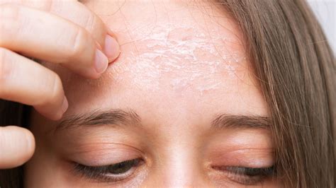 9 Causes For Dry Skin On Your Face How To Treat Them