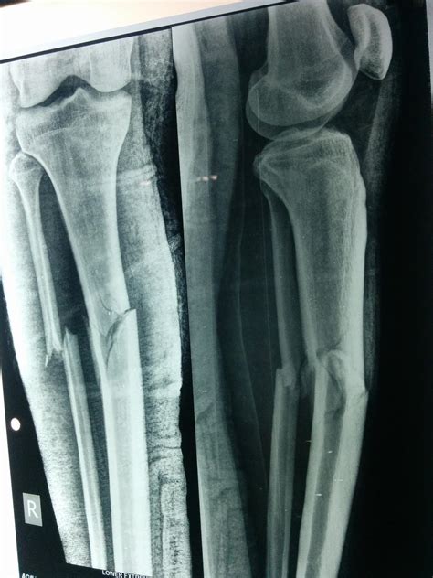 Proximal Third Tibia Fracture Trauma Orthobullets