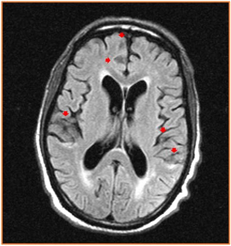 Figure 3 Mri Brain Of The Patient Showing Multiple Punctate Foci Red