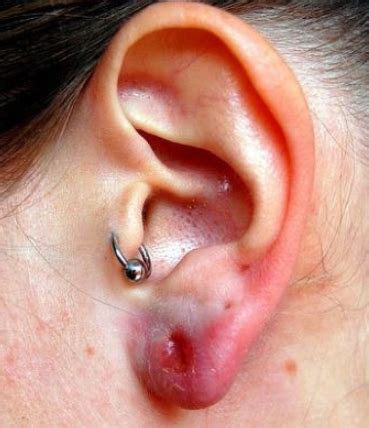 How to fix earring holes that stretched stories of silver silk. Ear Piercing Infection Causes, Treatment, Home Remedies ...