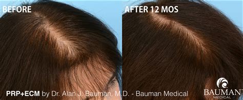 Prp Hair Regrowth Results In Female Patient · Bauman Medical