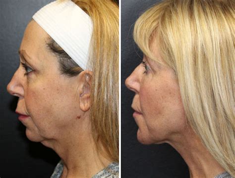 Non Surgical Neck Lift Is Necktite Or Renuvion Your Best Option For