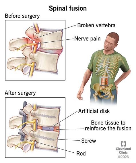 Spinal Fusion What It Is Purpose Procedure Risks Recovery