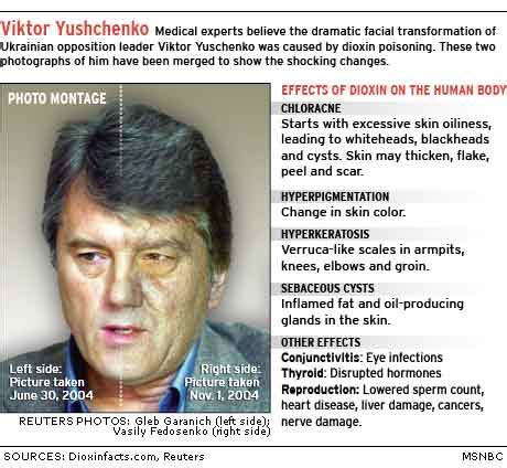 ❑ chloracne is a hallmark of dioxin toxicity in humans and can persist for years after exposure ceases. Yushchenko poisoned by most harmful dioxin - World news ...