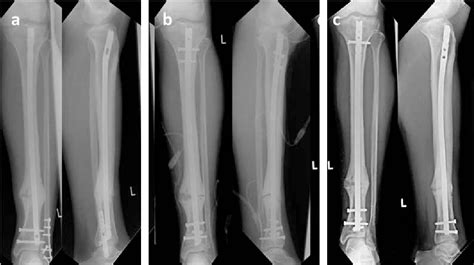 Figure 2 From Treatment Of Tibial Non Unions State Of The Art And