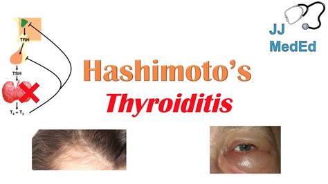 Hashimotos Thyroiditis What Is It Whos At Risk And What You Need To