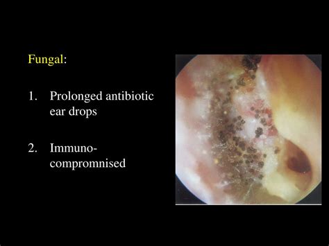 Ppt Diseases Of External Ear Powerpoint Presentation Free Download