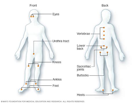 The symptoms of rheumatoid arthritis often develop gradually over several weeks, but some cases can progress quickly over a number of days. Reactive arthritis Disease Reference Guide - Drugs.com