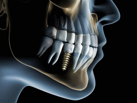 Dental Implants And Bone Loss Oral And Maxillofacial Associates Okc
