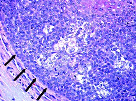 Inverted Follicular Keratosis With Sebaceoma Like Areas First Case