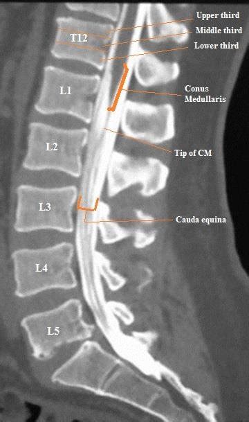 Coronal Ct Scan Of The Lumbar Spine Shows Spinal Column