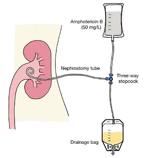 İllustration Of The Connection Of The Nephrostomy Tube Drainage Bag