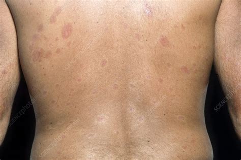 Skin Plaques In Systemic Sclerosis Stock Image C0223193 Science