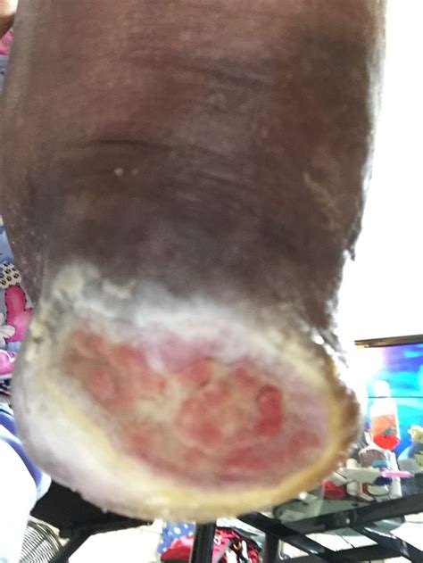 The term eschar is not interchangeable with scab. ENLUXTRA for Any Wound BLOG - ENLUXTRA