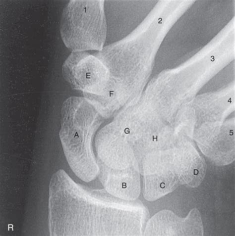 Pa Wrist Ulnar Deviation Radiograph Diagram Quizlet