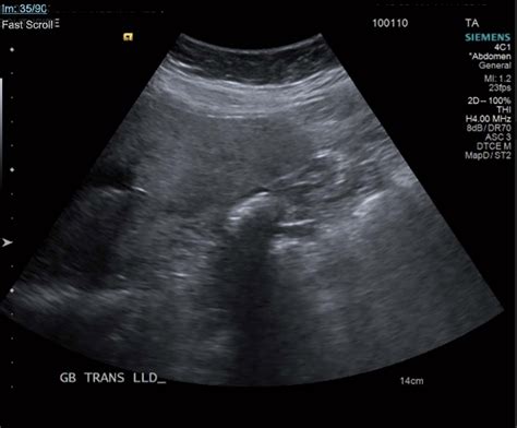 Ultrasound Of The Gallbladder Showing Echogenic Shadow From The
