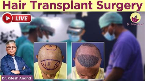 Live Hair Transplant Surgery Planning Marking Live Procedure