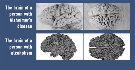 Dementia with lewy bodies and parkinson brain damage results from the accumulation of lewy bodies. Dementia Risk: 4 Habits That Destory Brain Health