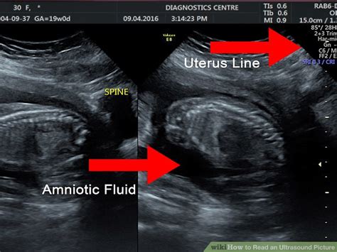How To Read An Ultrasound Picture 9 Steps With Pictures