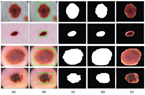 Skin Lesion Segmentation Results Of The Proposed Method A Original