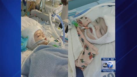 Conjoined Twins From Braidwood Successfully Separated In New York