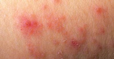 Can You Identify These Well Known Skin Conditions Healthgrades Com
