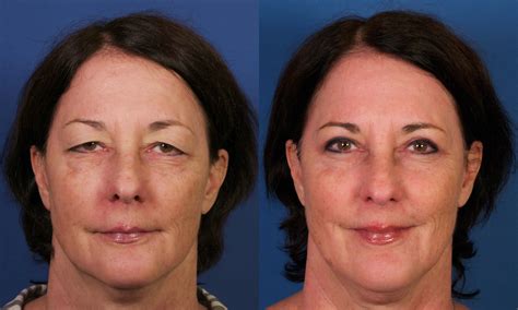 Eyelid Lift Surgery Blepharoplasty Before And After Pictures Dr My Xxx Hot Girl