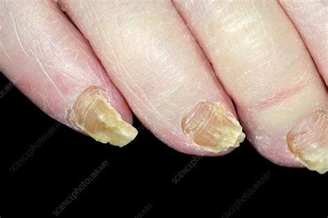 Fungal Nail Infection Stock Image C0370866 Science Photo Library