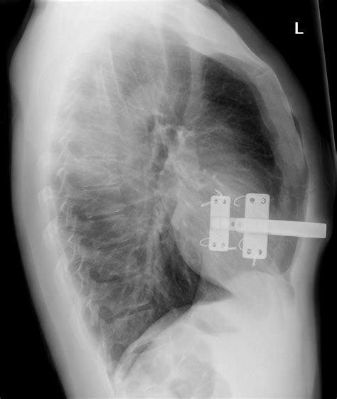 The main symptom of pectus carinatum is a breastbone that sticks out. Reverse Nuss procedure for pectus carinatum | Image ...