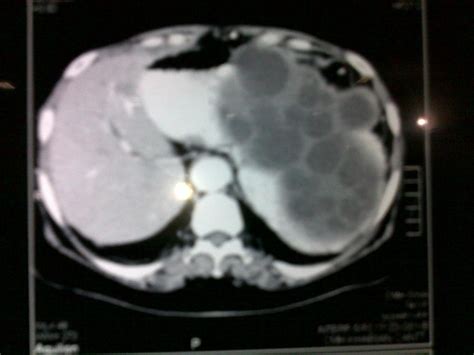 Case Report Removal Of A Large Hydatid Cyst In Spleen Anaesthesia