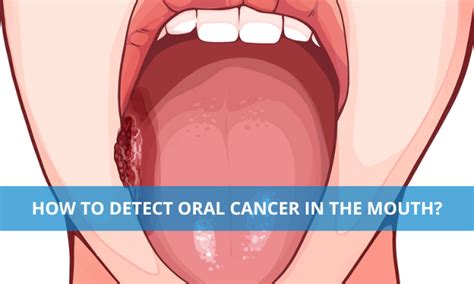 How To Detect Oral Cancer In The Mouth