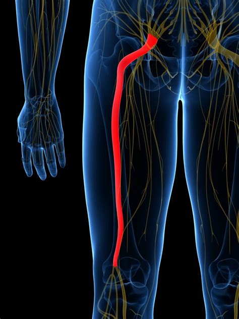 A pinched nerve occurs when too much pressure is applied to a nerve by surrounding tissues, such as bones, cartilage, muscles or tendons. Sciatica: What It Is, Common Causes, and How to Fix It ...