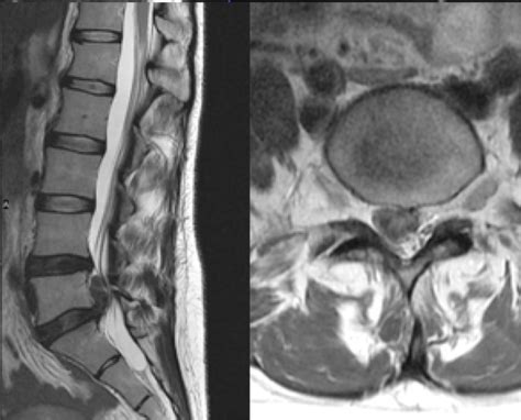 Cervical Spine Mri Herniated Disc