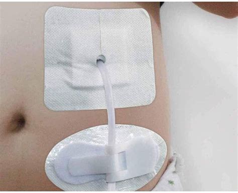 Buy Gtube Pads Holder G Tube Button Pads Trostomy Catheter Pd Dialysis