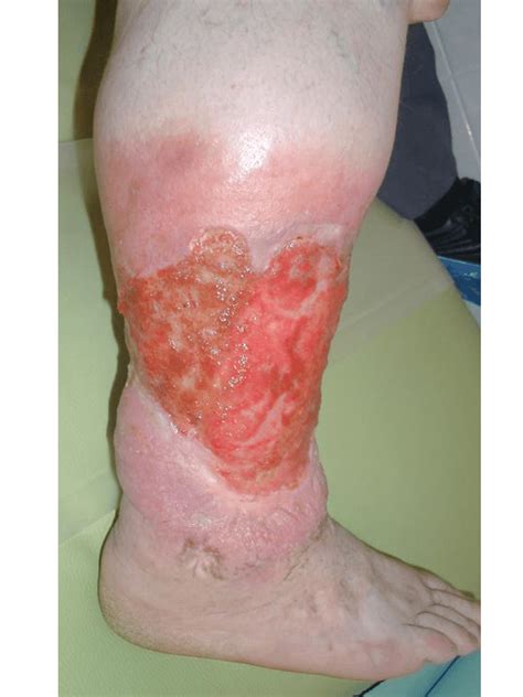 Ulcera varicosa La ulcera más común en la pierna