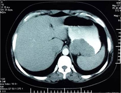 Abdominal Ct Scan Showing The Presence Of A Cystic Tumor Of Cm With A My XXX Hot Girl