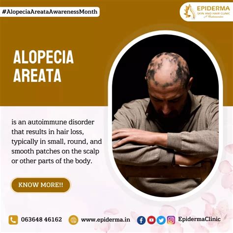 Ppt Alopecia Areata Awareness Dermatology Centre In Jayanagar