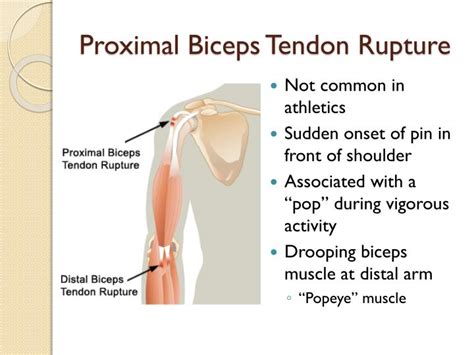How To Rehab A Complete Ruptured Bicep Tendon
