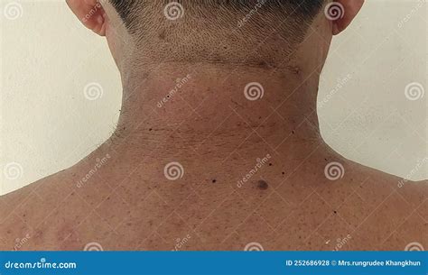 Inflammatory Acne On The Back Is Attached To The Nape Of The Male