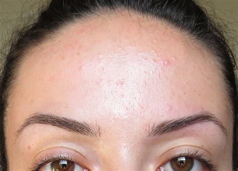 My Skins Journey Week 39 Banish Acne Scars