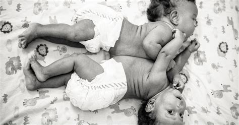 Conjoined Twins Are Separated And Photographed Popsugar Moms