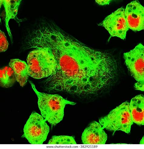 Real Fluorescence Microscopic View Human Neuroblastoma Stock Photo