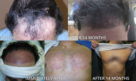 Before And After Picutres Artas Robotic Hair Transplant