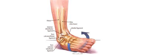 Ankle Sprain Rehab Symmetry Physical Therapy Downtown Miami